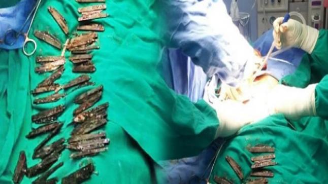 صدمة في أحد مستشفيات الهند بعد إخراج أربعين سكينا من بطن مريض